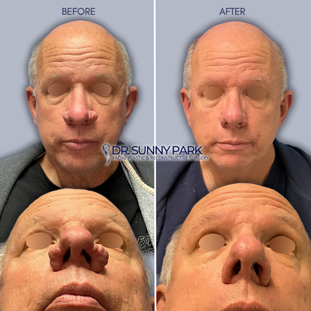 Before-and-After Facelift Results - Dr. Sunny Park | Top Plastic